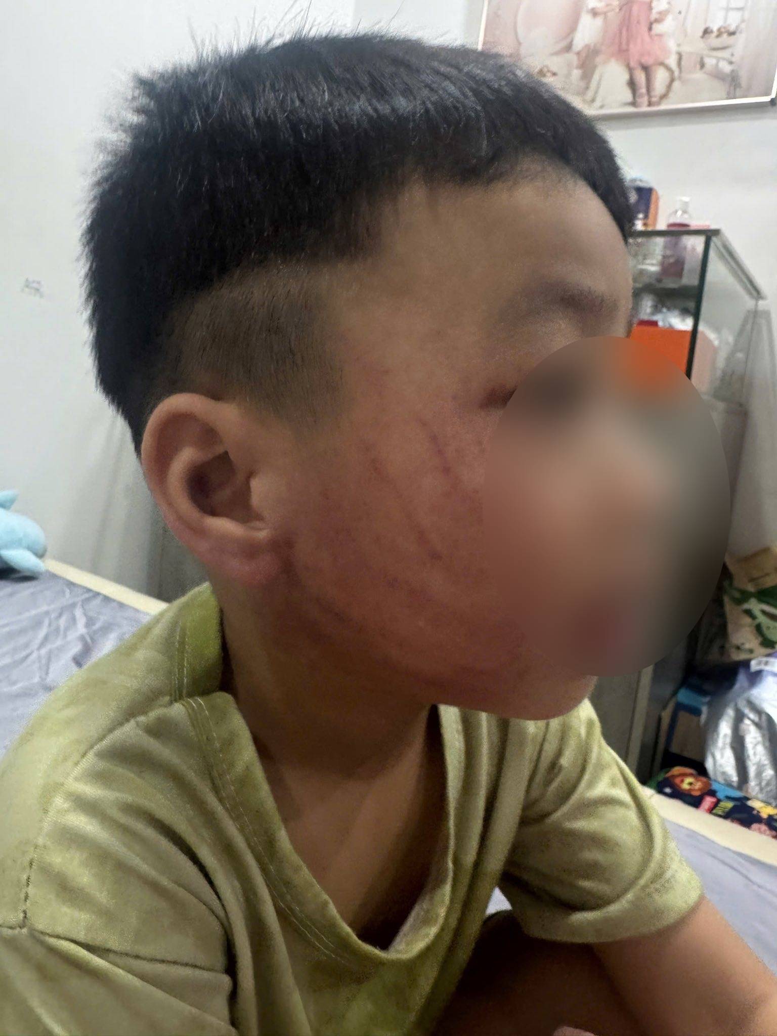 Xôn xao hình ảnh bé trai ở Hà Nội bị đánh tím mặt, phụ huynh phẫn nộ tố đích danh giáo viên- Ảnh 1.