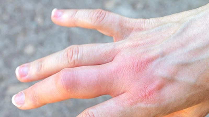 5 dấu hiệu xấu xí trên bàn tay cảnh báo thận của bạn đang kêu cứu!- Ảnh 3.