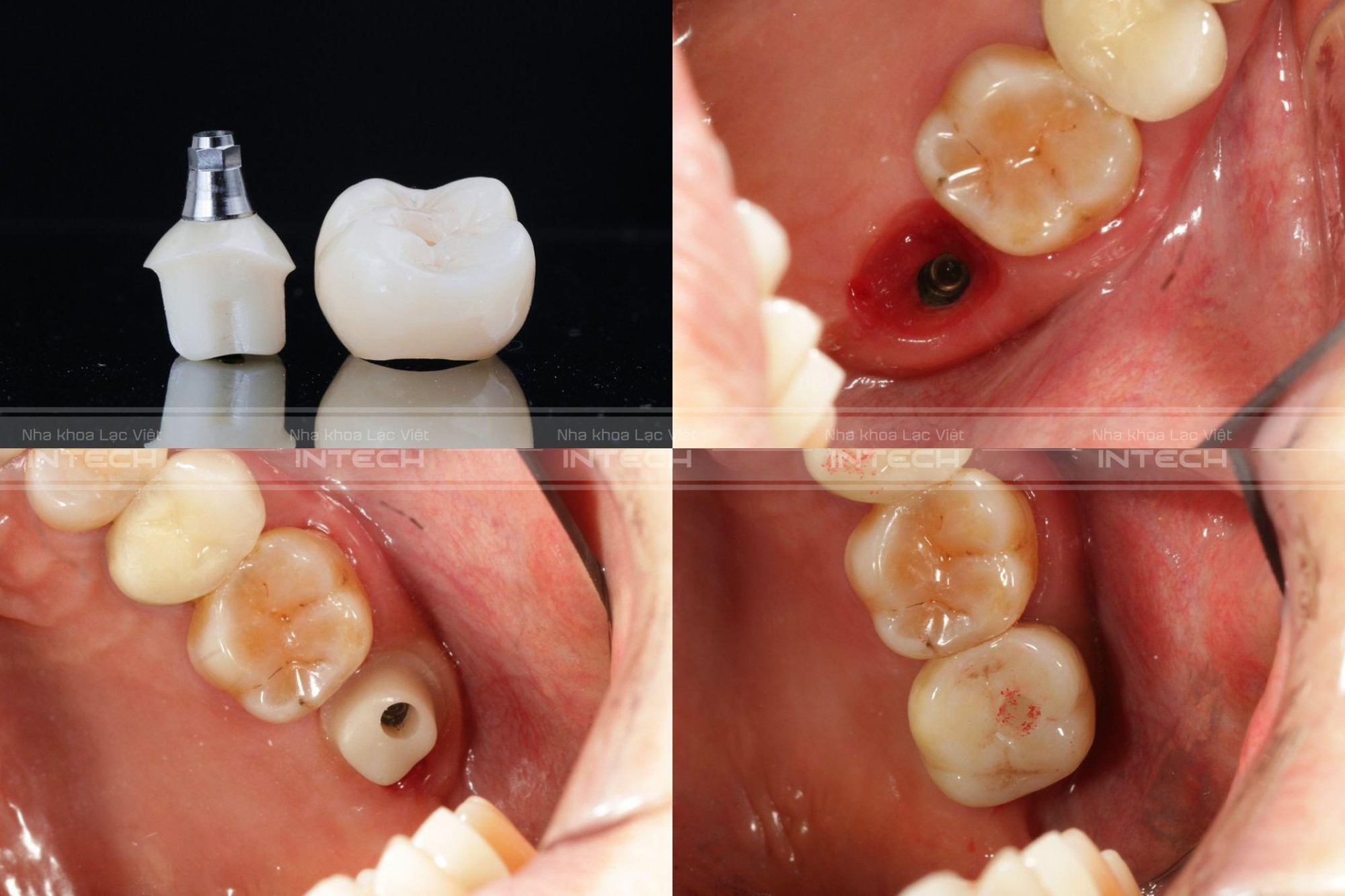 Nhược điểm của trồng răng Implant: Liệu Implant có thực sự hoàn hảo?- Ảnh 2.
