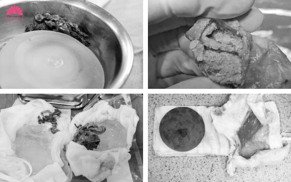 Sở hữu vòng 1 đẹp an toàn với xu hướng nâng ngực 4 không- Ảnh 1.