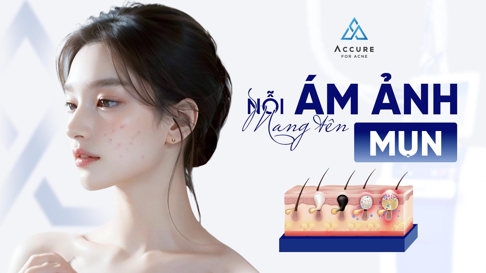 TRANFA chính thức đưa công nghệ laser bước sóng 1726nm phá hủy tuyến bã Accure về Việt Nam- Ảnh 1.