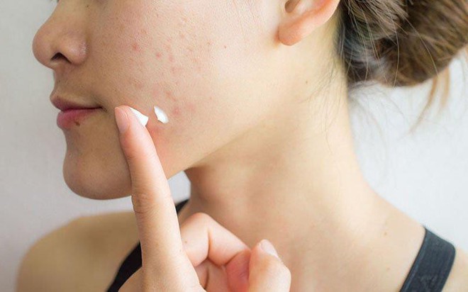 Kem chấm mụn có thực sự cần đến hoạt chất treatment mạnh mới đem lại hiệu quả?- Ảnh 1.