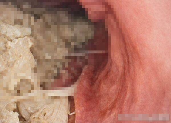 Người phụ nữ 54 tuổi "liệt dạ dày", nhịn 12 tiếng thức ăn trong bụng vẫn còn nguyên vì dùng 1 thứ để giảm cân- Ảnh 1. Người phụ nữ 54 tuổi "liệt dạ dày", nhịn 12 tiếng thức ăn trong bụng vẫn còn nguyên vì dùng 1 thứ để giảm cân- Ảnh 1.