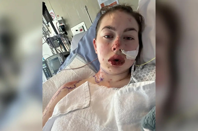 Uống thuốc điều trị trầm cảm, cô gái 23 tuổi gặp phản ứng bị "đốt cháy" từ trong ra ngoài- Ảnh 1.