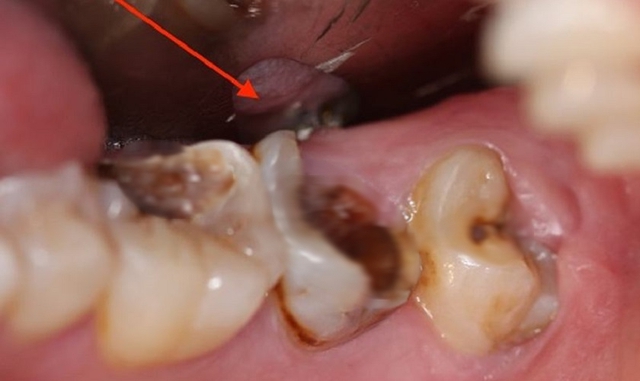 Bí mật về răng số 6: chiếc răng vĩnh viễn hay bị lãng quên và chưa được quan tâm đúng mức- Ảnh 2.