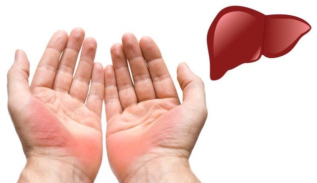 1 bộ phận cơ thể có mùi hôi là dấu hiệu nguy cơ ung thư gan, nhiều người không biết lại cứ giấu- Ảnh 3.