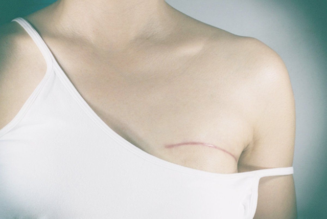 Tái tạo vú: Cuộc hồi sinh của người phụ nữ sau "vết sẹo vô hình"- Ảnh 3.
