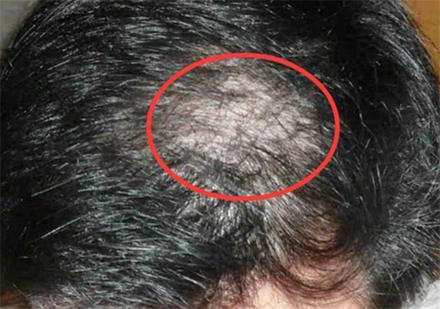 Nữ sinh 14 tuổi rụng sạch tóc vì thói quen này của nhiều người- Ảnh 1.
