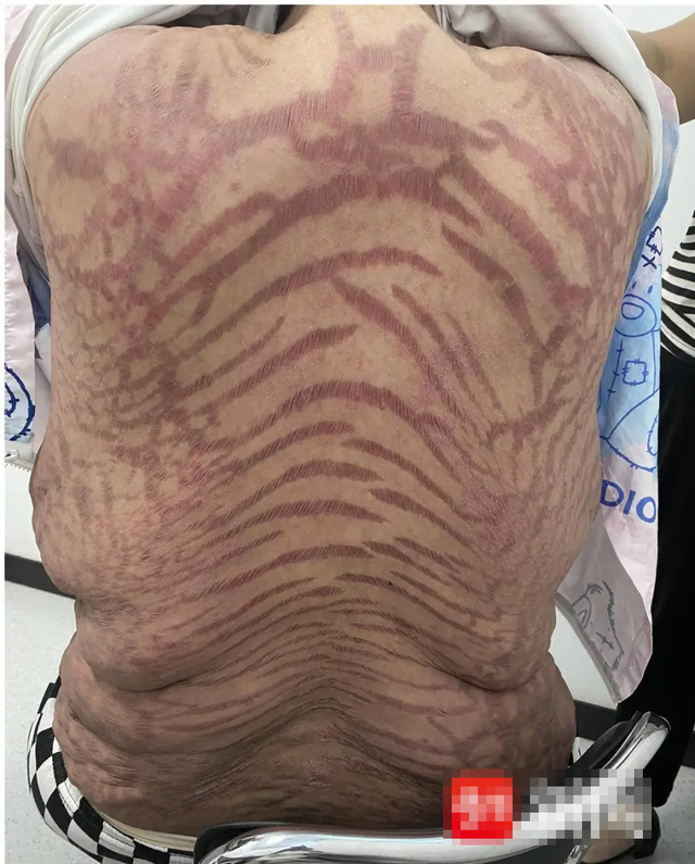 Da đầy vết rạn như da rắn vì thuốc mỡ bôi da mua trên mạng- Ảnh 1.