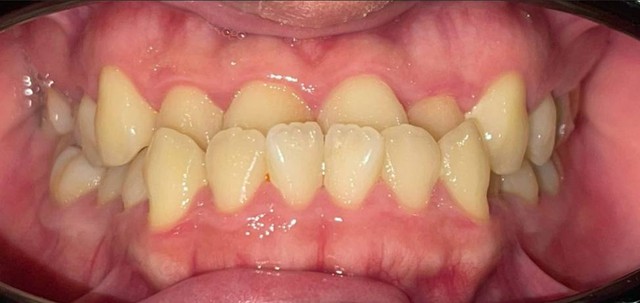 Đau đầu triền miên vi răng chen chúc: Hành trình lấy lại sự tự tin của chàng trai Tiktoker- Ảnh 1.