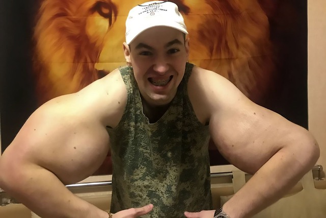 Tiêm chất làm phồng cơ bắp đến dị dạng, "quái vật thể hình" đối diện nguy cơ phải cắt cụt hai cánh tay?- Ảnh 4. Tiêm chất làm phồng cơ bắp đến dị dạng, "quái vật thể hình" đối diện nguy cơ phải cắt cụt hai cánh tay?- Ảnh 4.