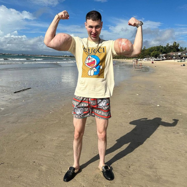 Tiêm chất làm phồng cơ bắp đến dị dạng, "quái vật thể hình" đối diện nguy cơ phải cắt cụt hai cánh tay?- Ảnh 1. Tiêm chất làm phồng cơ bắp đến dị dạng, "quái vật thể hình" đối diện nguy cơ phải cắt cụt hai cánh tay?- Ảnh 1.