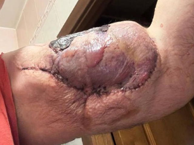 Tiêm chất làm phồng cơ bắp đến dị dạng, "quái vật thể hình" đối diện nguy cơ phải cắt cụt hai cánh tay?- Ảnh 3. Tiêm chất làm phồng cơ bắp đến dị dạng, "quái vật thể hình" đối diện nguy cơ phải cắt cụt hai cánh tay?- Ảnh 3.