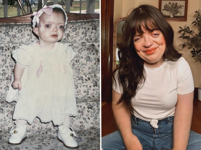 Tôi đã che giấu khuôn mặt suốt nhiều năm, nhưng giờ tôi tự hào chấp nhận vẻ khác biệt của chính mình- Ảnh 1. Tôi đã che giấu khuôn mặt suốt nhiều năm, nhưng giờ tôi tự hào chấp nhận vẻ khác biệt của chính mình- Ảnh 1.