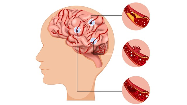 Hiếm gặp: Thiếu niên 17 tuổi bị đột quỵ, dấu hiệu ban đầu dễ nhầm lẫn nên bị bỏ qua- Ảnh 2.