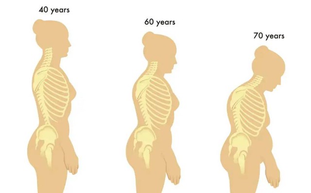40 tuổi nhưng sáng nào ngủ dậy cũng đau lưng, tôi giật mình khi bác sĩ nói "mắc bệnh của người già"- Ảnh 4.