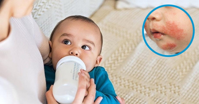 Sữa thủy phân là gì? Khi nào cha mẹ cần cho bé sử dụng sữa thủy phân?- Ảnh 2.