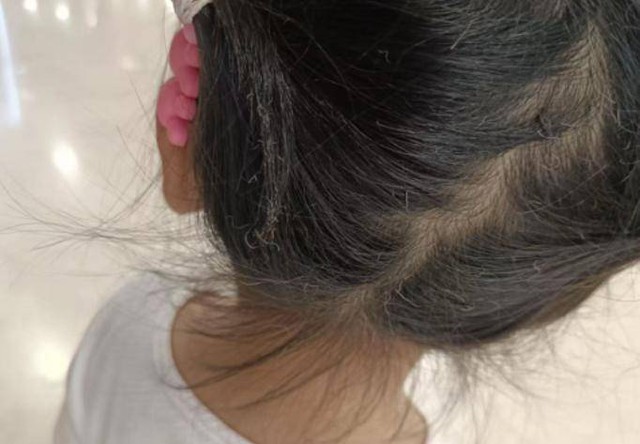 Bóng bay phát nổ khiến bé gái bị cháy sém tóc, người mẹ đăng đàn cảnh báo phụ huynh không nên mua loại bóng này- Ảnh 2.