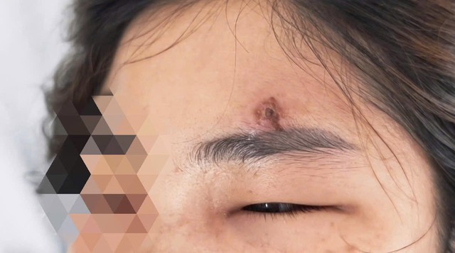 Tự nặn mụn ở trán, người phụ nữ U40 phải trả giá đắt- Ảnh 1.