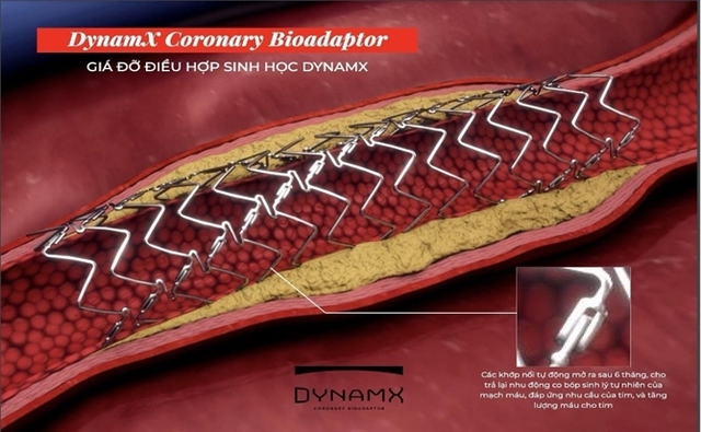 Stent tương thích sinh học thế hệ mới giảm biến chứng tim mạch- Ảnh 2. Stent tương thích sinh học thế hệ mới giảm biến chứng tim mạch- Ảnh 2.