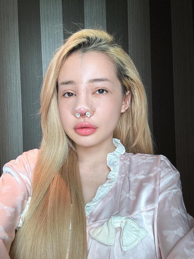 Ngân 98 bị biến chứng nhiễm trùng nặng sau 11 lần phẫu thuật thẩm mỹ- Ảnh 10. Ngân 98 bị biến chứng nhiễm trùng nặng sau 11 lần phẫu thuật thẩm mỹ- Ảnh 10.