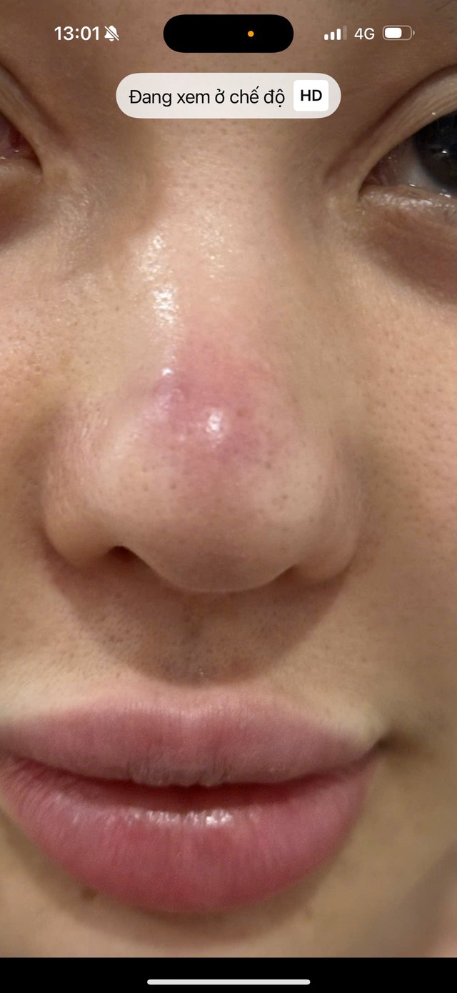 Ngân 98 bị biến chứng nhiễm trùng nặng sau 11 lần phẫu thuật thẩm mỹ- Ảnh 4. Ngân 98 bị biến chứng nhiễm trùng nặng sau 11 lần phẫu thuật thẩm mỹ- Ảnh 4.