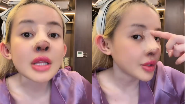 Ngân 98 bị biến chứng nhiễm trùng nặng sau 11 lần phẫu thuật thẩm mỹ- Ảnh 9. Ngân 98 bị biến chứng nhiễm trùng nặng sau 11 lần phẫu thuật thẩm mỹ- Ảnh 9.