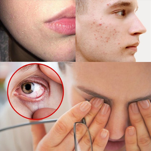Cơ thể đang thiếu vitamin, trên khuôn mặt sẽ xuất hiện những dấu hiệu này: Đừng chủ quan mà suy kiệt sức khỏe- Ảnh 3.