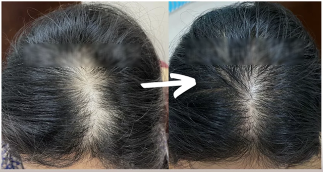 Cô gái 29 tuổi tóc đã rụng hói đầu, bác sĩ: Ngăn ngừa rụng tóc, kích thích mọc tóc cần tránh xa những thứ này- Ảnh 1.