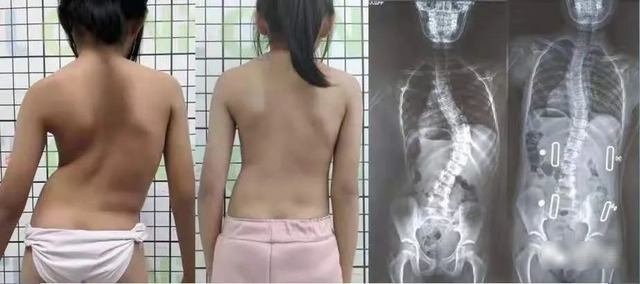 Cột sống của nữ sinh 16 tuổi cong gập 45 độ! Bác sĩ: Cứ 20 trẻ thì có 1 trẻ bị- Ảnh 1.