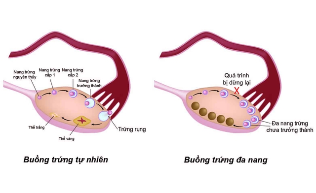Chuyên gia hướng dẫn cách phân biệt hội chứng buồng trứng đa nang và lạc nội mạc tử cung: Những ai có nguy cơ cao?- Ảnh 2.