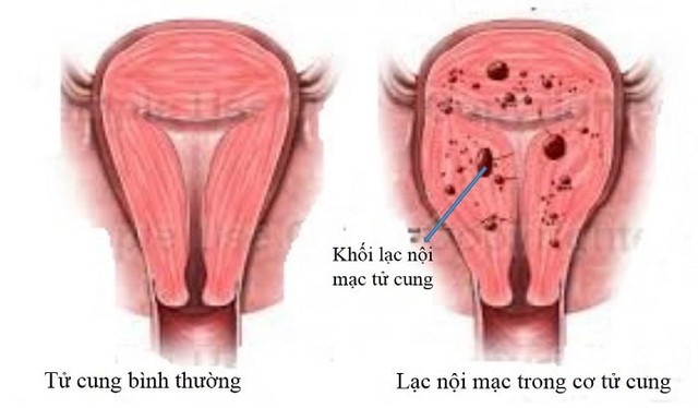 Chuyên gia hướng dẫn cách phân biệt hội chứng buồng trứng đa nang và lạc nội mạc tử cung: Những ai có nguy cơ cao?- Ảnh 3.