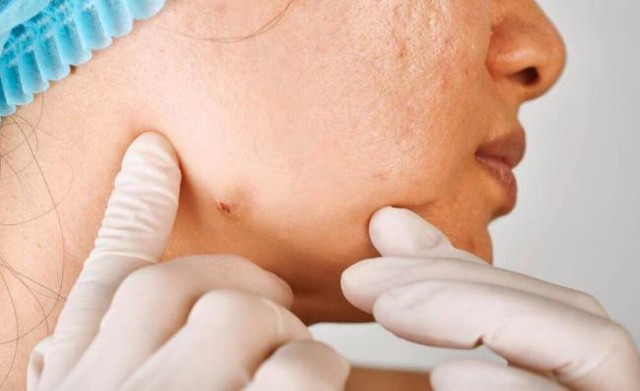 3 loại "mụn" này trên cơ thể có thể là ung thư, dù nam hay nữ, ở độ tuổi nào cũng đừng bỏ qua- Ảnh 1.