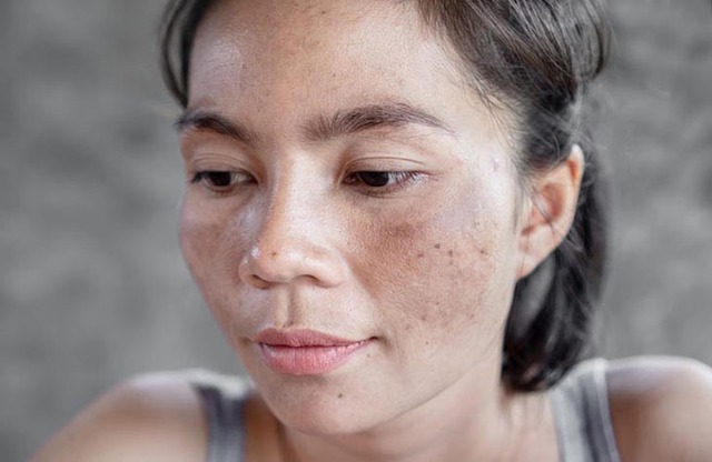 Loại lá trong vườn có tác dụng trị nám, làm sáng da nhanh chóng: Mùa hè có thể dùng để uống hoặc đắp mặt nạ- Ảnh 1.