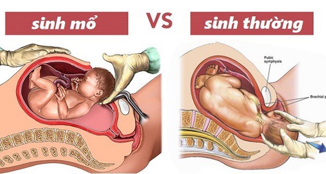 Chọn giờ sinh mổ để được "giờ tốt, ngày tốt": Những rủi ro ít mẹ lường được- Ảnh 2. Chọn giờ sinh mổ để được "giờ tốt, ngày tốt": Những rủi ro ít mẹ lường được- Ảnh 2.