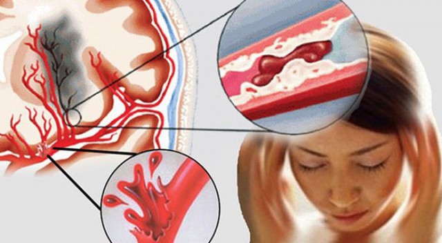 Nữ MC đột ngột qua đời ở tuổi 27: Cảnh báo thói quen sống âm thầm "châm ngòi" cho căn bệnh này ở người trẻ- Ảnh 3.
