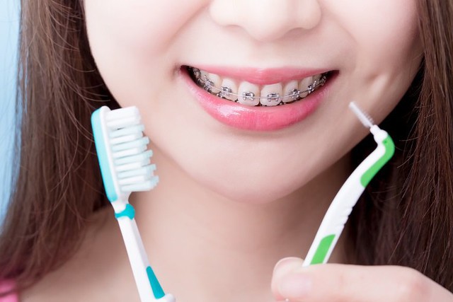 Những sai lầm trong chăm sóc răng miệng khi đang niềng: Cẩn trọng kẻo "mất cả hàm răng"- Ảnh 1.