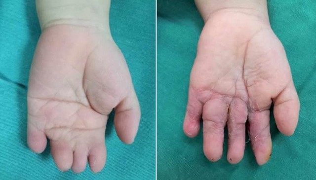 Thai nhi 21 tuần bị cắt cụt các ngón tay vì một thứ "sắc hơn dao" ngay trong bụng mẹ: Nguy hiểm nhưng khó phát- Ảnh 5.