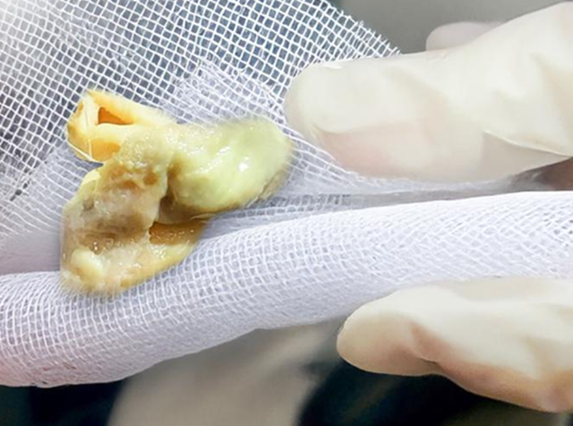 Chảy mũi có mùi hôi sau 5 ngày nâng mũi, người phụ nữ tá hỏa phát hiện "thứ bị bỏ quên" bên trong- Ảnh 1.