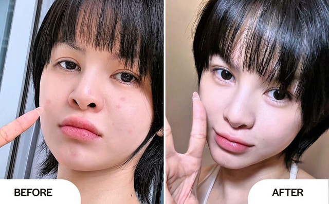 Serum Neutidi Niacinamide 10% có thật sự cải thiện làn da mụn và thâm sạm?- Ảnh 5. Serum Neutidi Niacinamide 10% có thật sự cải thiện làn da mụn và thâm sạm?- Ảnh 5.