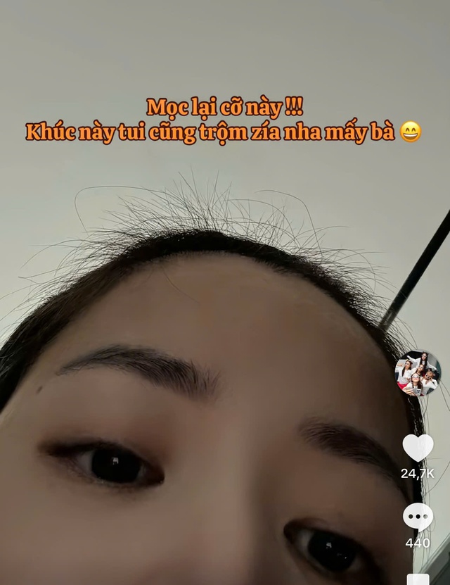 Puka gây lo lắng khi tóc rụng la liệt thành từng mảng sau khi sinh con đầu lòng- Ảnh 3.