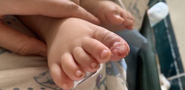 Con bị cục biến áp điện rơi vào chân đến biến dạng nhưng mẹ không dám cho đi khám vì bà ngoại mắng "thừa tiền"- Ảnh 2.