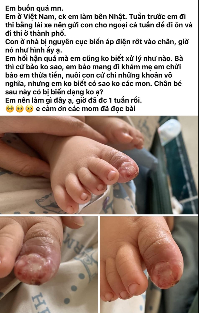 Con bị cục biến áp điện rơi vào chân đến biến dạng nhưng mẹ không dám cho đi khám vì bà ngoại mắng "thừa tiền"- Ảnh 1.