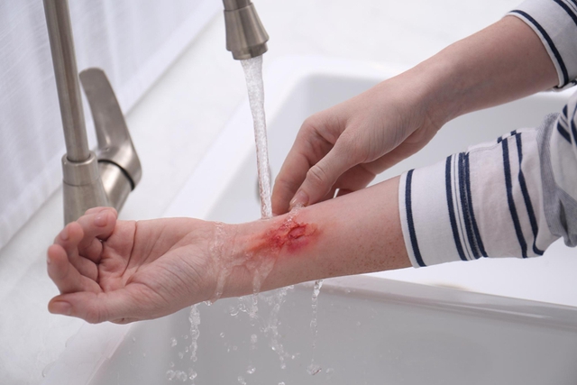 Hướng dẫn chi tiết quy trình rửa vết thương hở nhỏ tại nhà để tránh những biến chứng nguy hiểm- Ảnh 3.