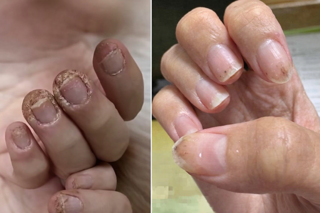 Cô gái 28 tuổi móng tay "mục như gỗ", chạm nhẹ là rụng cả mảng vì sở thích "vạn người mê" của các chị em- Ảnh 1.