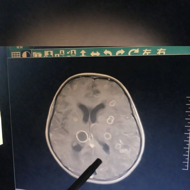 Bé gái lớp 2 não "bị ăn mòn chục lỗ", chậm chút là rỗng hoàn toàn: Thủ phạm rất phổ biến trong mọi gia đình- Ảnh 1.