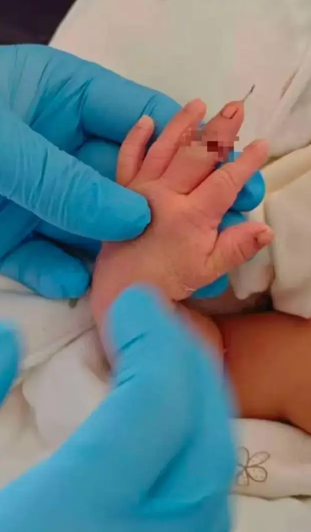 Trẻ sơ sinh bị đứt ngón tay khi nữ hộ sinh tiến hành cắt dây rốn- Ảnh 1. Trẻ sơ sinh bị đứt ngón tay khi nữ hộ sinh tiến hành cắt dây rốn- Ảnh 1.