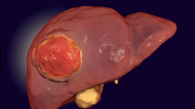 Bác sĩ chỉ ra 5 thói quen ăn uống nuôi "ung thư gan" của nhiều người trẻ- Ảnh 1.