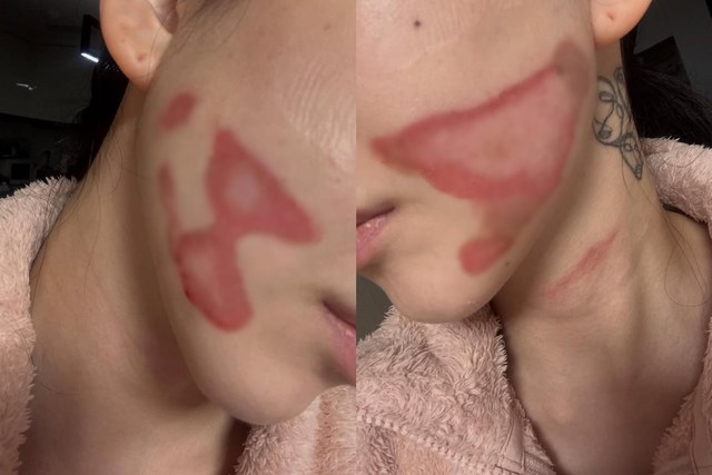 Nữ ca sĩ mất Tết, bị bỏng nặng một bên mặt khi đi làm đẹp- Ảnh 2.