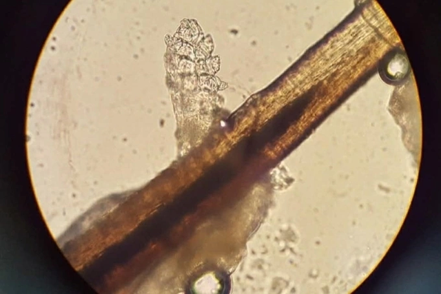 Cô gái "nuôi đàn rận" trên mí mắt không hay biết sau khi làm đẹp bằng phương pháp nhiều chị em cực mê - Ảnh 1.